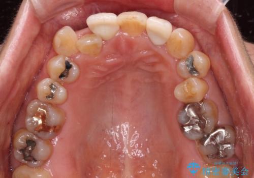 変色した前歯をオールセラミッククラウンで自然な口元にの治療後