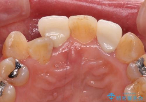 変色した前歯をオールセラミッククラウンで自然な口元にの治療後