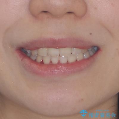 骨格的なズレをカムフラージュ 抜歯矯正で咬み合わせを改善の治療後(顔貌)