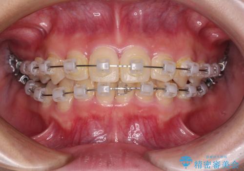 楽してクロスバイトを治したい ワイヤー装置による矯正治療の治療中