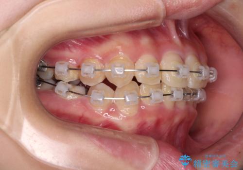 楽してクロスバイトを治したい ワイヤー装置による矯正治療の治療中