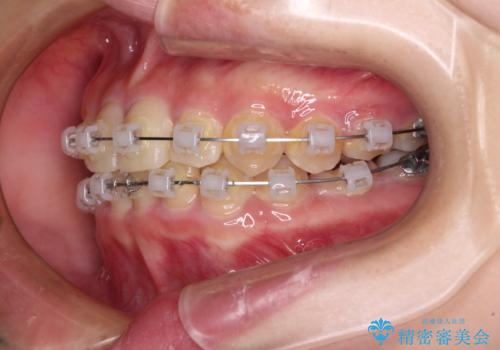 楽してクロスバイトを治したい ワイヤー装置による矯正治療の治療中