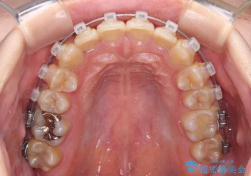 楽してクロスバイトを治したい ワイヤー装置による矯正治療の治療中