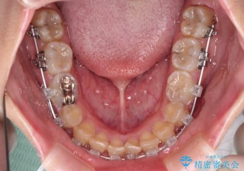 楽してクロスバイトを治したい ワイヤー装置による矯正治療の治療中