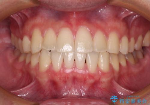 【モニター】前歯のクロスバイトと隙間を改善　インビザラインによる矯正治療の症例 治療後