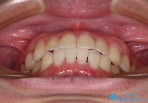 【モニター】前歯のクロスバイトと隙間を改善 インビザラインによる矯正治療の治療後