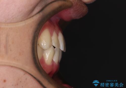 【モニター】前歯のクロスバイトと隙間を改善 インビザラインによる矯正治療の治療後