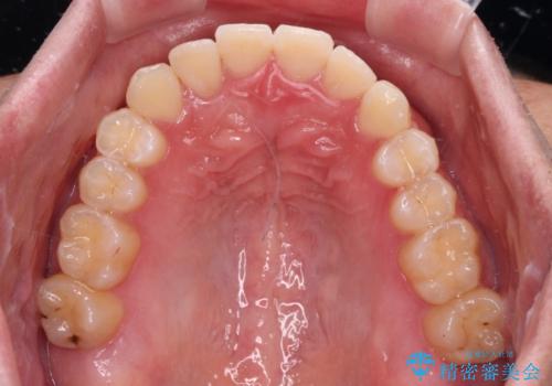 【モニター】前歯のクロスバイトと隙間を改善 インビザラインによる矯正治療の治療後