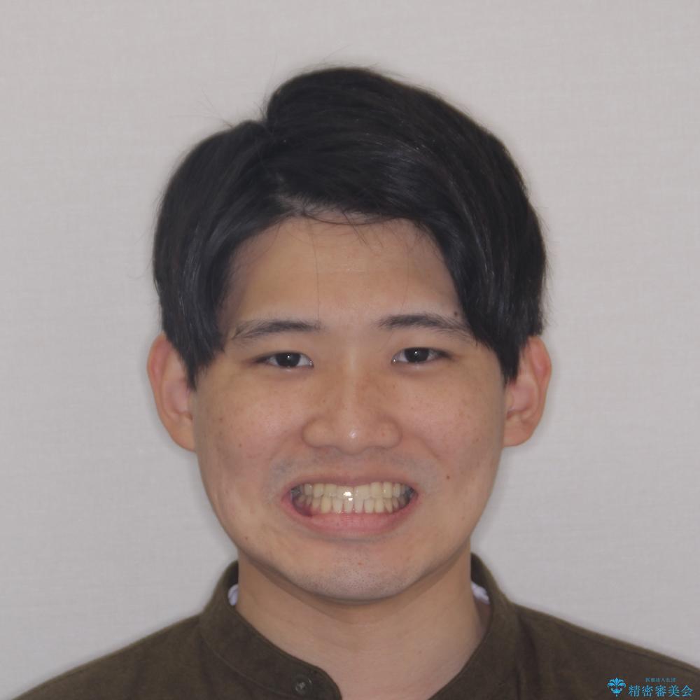 【モニター】前歯のクロスバイトと隙間を改善 インビザラインによる矯正治療の治療後(顔貌)