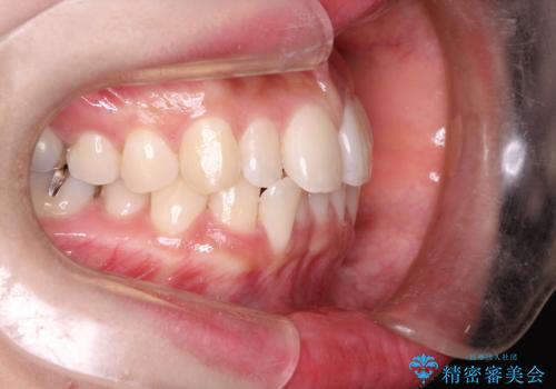 【すきっ歯・引っ込んだ前歯でお悩みの方必見】インビザライン矯正の症例の治療前