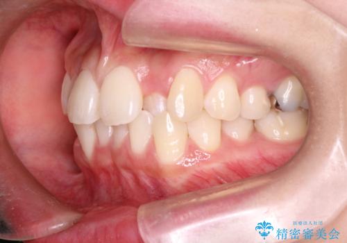 【すきっ歯・引っ込んだ前歯でお悩みの方必見】インビザライン矯正の症例の治療前