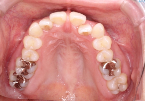 【すきっ歯・引っ込んだ前歯でお悩みの方必見】インビザライン矯正の症例の治療前