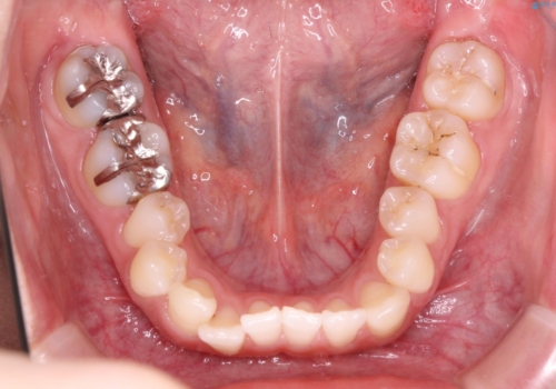 【すきっ歯・引っ込んだ前歯でお悩みの方必見】インビザライン矯正の症例の治療前