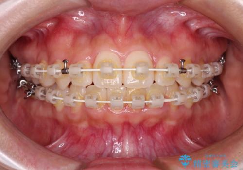 前歯のクロスバイト 目立たないワイヤー装置で速やかに矯正治療の治療中
