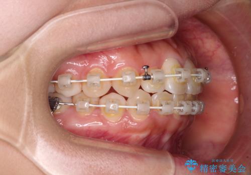 前歯のクロスバイト 目立たないワイヤー装置で速やかに矯正治療の治療中