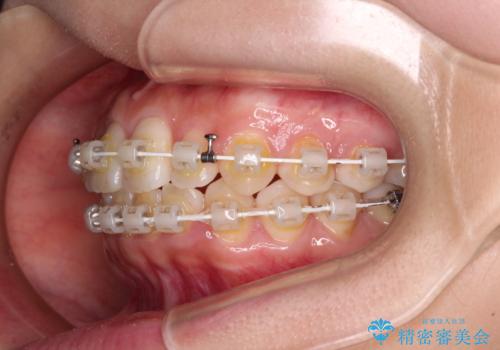 前歯のクロスバイト 目立たないワイヤー装置で速やかに矯正治療の治療中