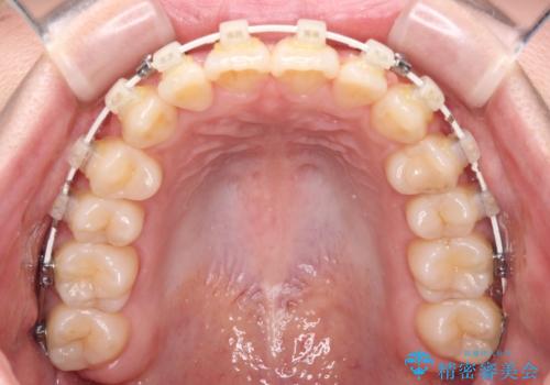 前歯のクロスバイト 目立たないワイヤー装置で速やかに矯正治療の治療中