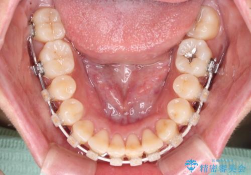 前歯のクロスバイト　目立たないワイヤー装置で速やかに矯正治療の治療中