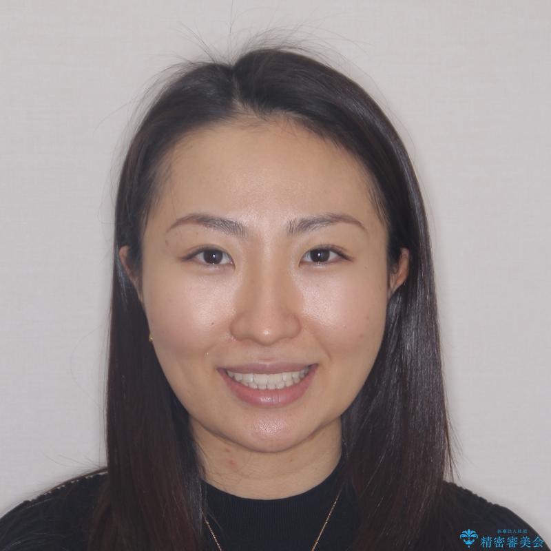 【モニター】前歯のすきっ歯をインビザラインで改善の治療後(顔貌)