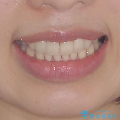 出産をしながら歯列を整える インビザラインによる矯正治療の治療後(顔貌)