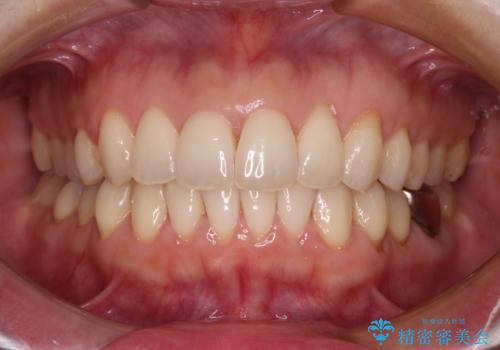 出産をしながら歯列を整える インビザラインによる矯正治療の治療後