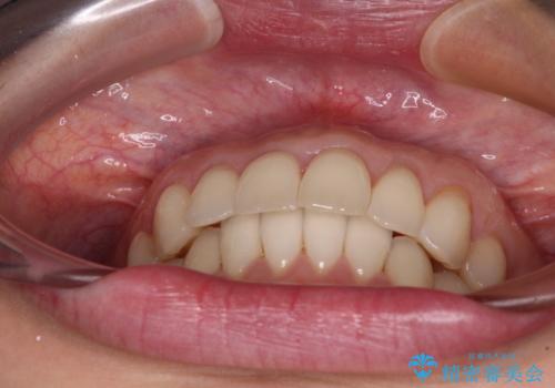 出産をしながら歯列を整える インビザラインによる矯正治療の治療後