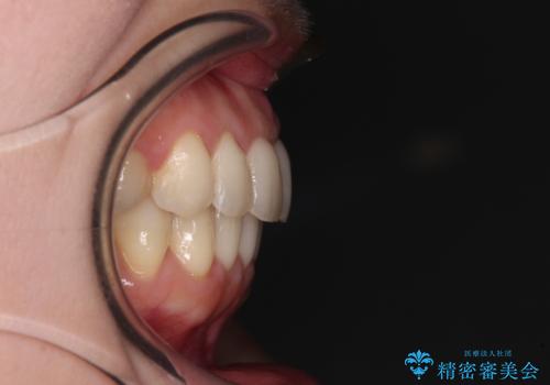 出産をしながら歯列を整える インビザラインによる矯正治療の治療後