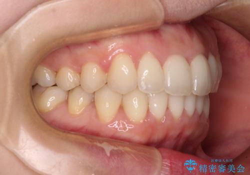 出産をしながら歯列を整える インビザラインによる矯正治療の治療後