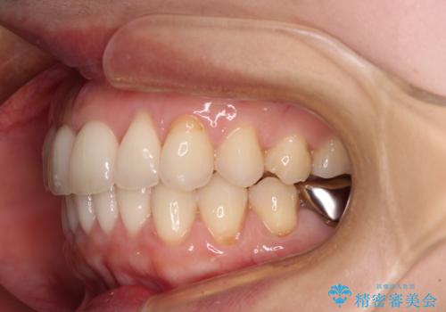 出産をしながら歯列を整える インビザラインによる矯正治療の治療後
