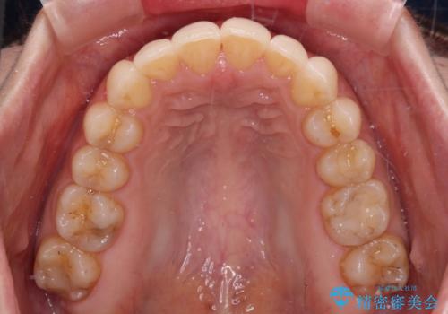 出産をしながら歯列を整える インビザラインによる矯正治療の治療後