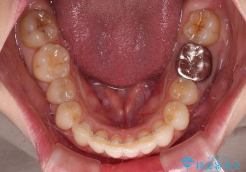 出産をしながら歯列を整える インビザラインによる矯正治療の治療後