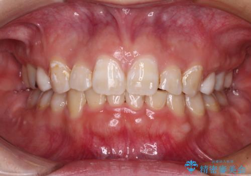 著しい八重歯を短期間で改善　ワイヤー装置による抜歯矯正の症例 治療後
