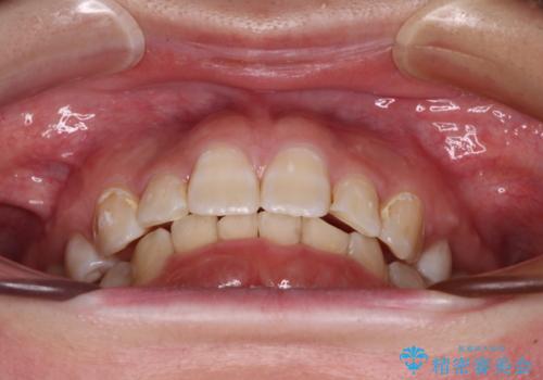 著しい八重歯を短期間で改善　ワイヤー装置による抜歯矯正の治療後