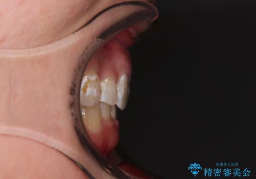 著しい八重歯を短期間で改善 ワイヤー装置による抜歯矯正の治療後