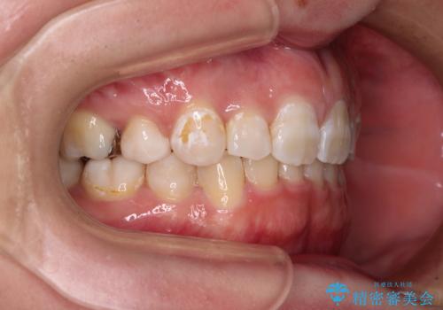 著しい八重歯を短期間で改善 ワイヤー装置による抜歯矯正の治療後