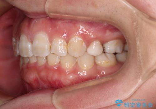 著しい八重歯を短期間で改善 ワイヤー装置による抜歯矯正の治療後