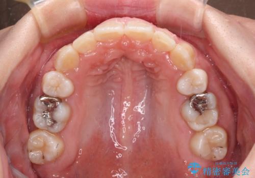 著しい八重歯を短期間で改善 ワイヤー装置による抜歯矯正の治療後
