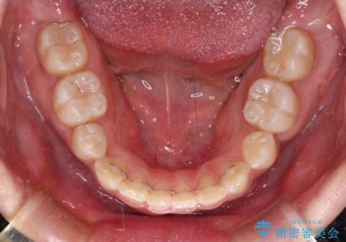 著しい八重歯を短期間で改善　ワイヤー装置による抜歯矯正の治療後