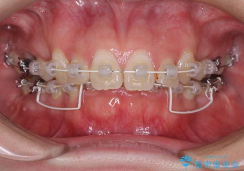 著しい八重歯を短期間で改善 ワイヤー装置による抜歯矯正の治療中