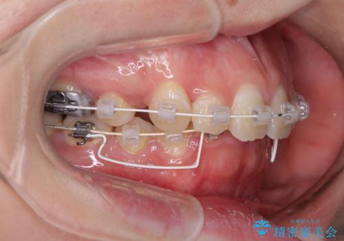 著しい八重歯を短期間で改善　ワイヤー装置による抜歯矯正の治療中