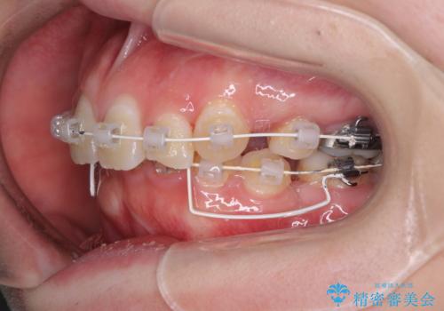 著しい八重歯を短期間で改善 ワイヤー装置による抜歯矯正の治療中
