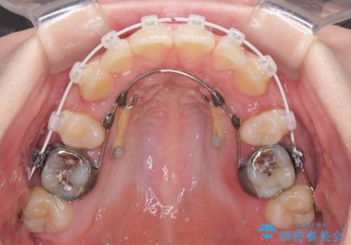 著しい八重歯を短期間で改善　ワイヤー装置による抜歯矯正の治療中