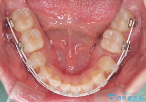著しい八重歯を短期間で改善 ワイヤー装置による抜歯矯正の治療中
