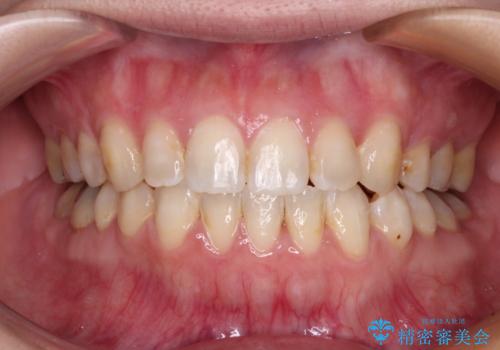 八重歯と前歯の欠損と骨格のズレ　目立たないワイヤー矯正