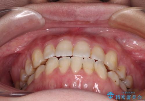 八重歯と前歯の欠損と骨格のズレ 目立たないワイヤー矯正の治療後