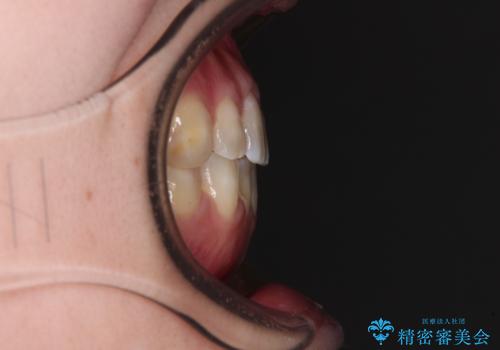 八重歯と前歯の欠損と骨格のズレ 目立たないワイヤー矯正の治療後