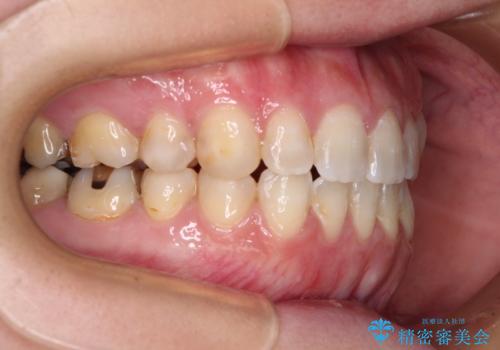 八重歯と前歯の欠損と骨格のズレ　目立たないワイヤー矯正の治療後