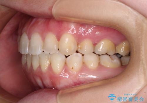 八重歯と前歯の欠損と骨格のズレ 目立たないワイヤー矯正の治療後