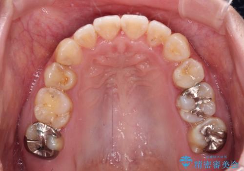 八重歯と前歯の欠損と骨格のズレ 目立たないワイヤー矯正の治療後
