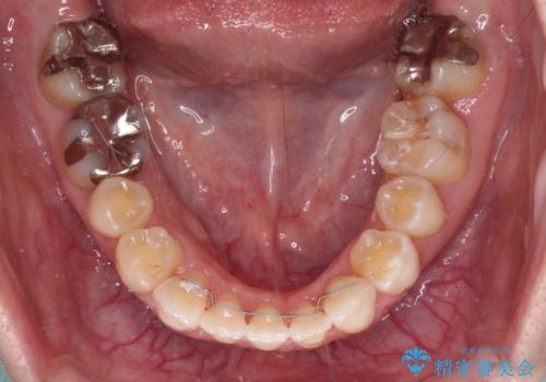 八重歯と前歯の欠損と骨格のズレ 目立たないワイヤー矯正の治療後